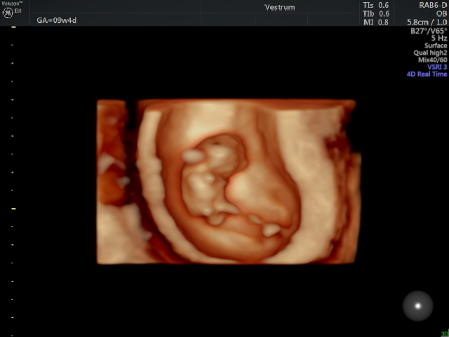 Early-Pregnancy.-3D-image-of-a-baby-at-9-weeks-gestation