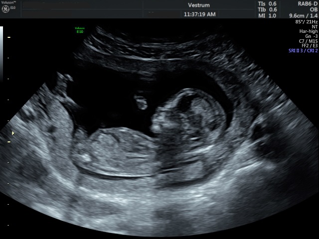 First-Trimester-Screening-Scan.-A-baby-at-13-weeks-gestation