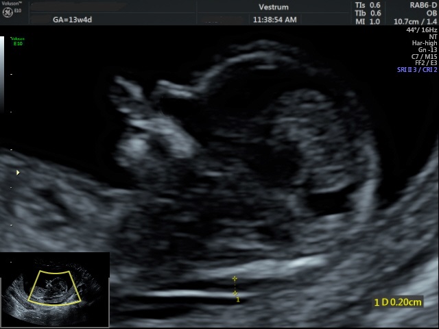 First-Trimester-Screening.-Ultrasound-screening-for-Down-Syndrome