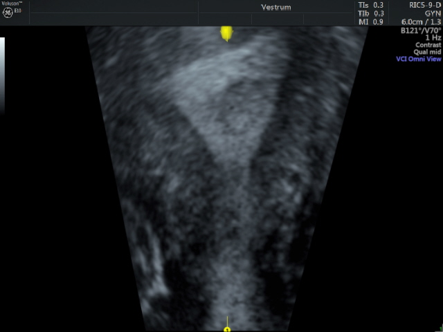 Pelvic-Scan.-3D-image-of-an-endometrial-polyp