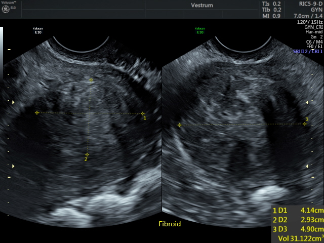 Pelvic-Scan.-A-uterine-fibroid-our-scans-will-localise-fibroids-to-help-further-treatment