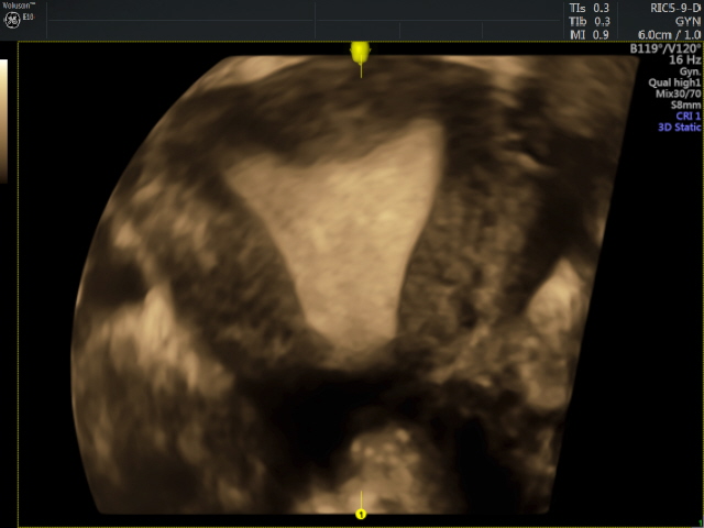 Pelvic-cavity.-4D-image-of-a-uterine-cavity