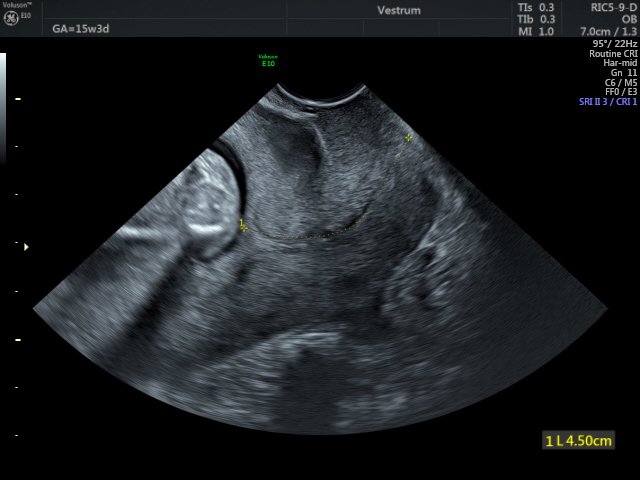 Premature-labour-assessment-by-ultrasound.-Cervical-length-assessment-in-pregnancy